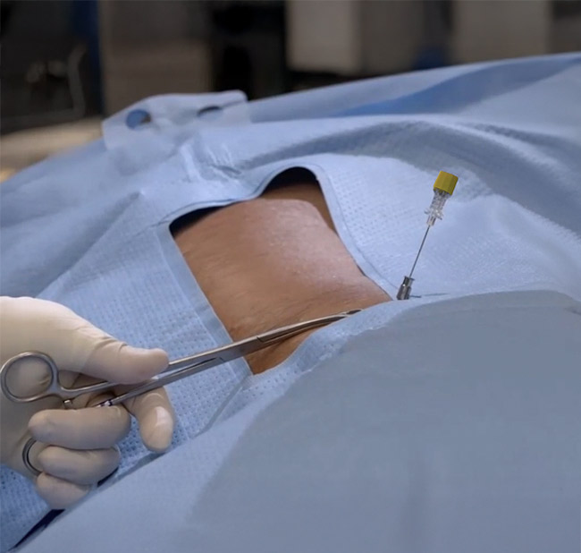 Degenerative disc disease patient during via disc injection procedure