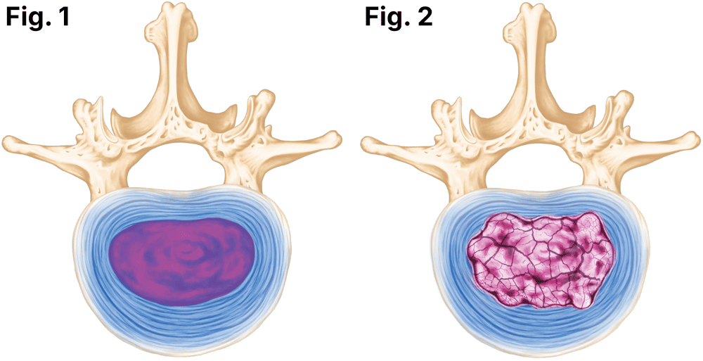 Two top-down view medical illustrations of vertebral bones and spinal disc material showing a healthy spinal disc (left) and a degenerated spinal disc (right).
